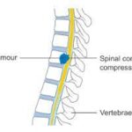 slip disc treatment in indore for early symptoms and back pain