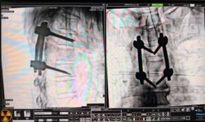 T5 Spinal Metastasis from Carcinoma Prostate, Treated with Dorsal Spine Decompression and Fixation